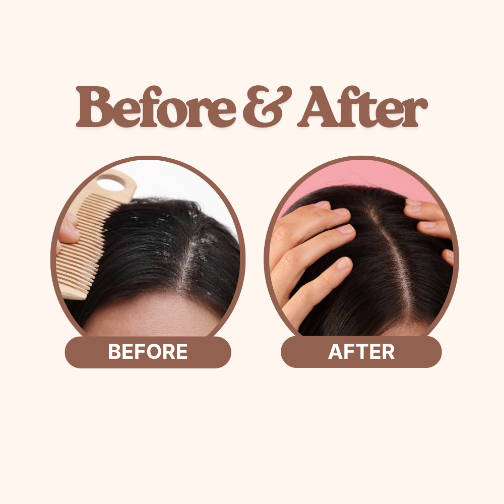 Lice Off Anti-Lice Shampoo – Fast & Natural Head Lice Treatment, 200ml